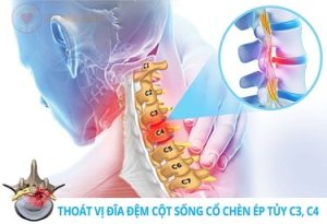 ĐAI KÉO GIÃN CỘT SỐNG CỔ 2