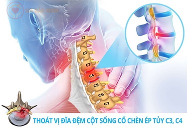 ĐAI KÉO GIÃN CỘT SỐNG CỔ GBM-006 - Ảnh 11